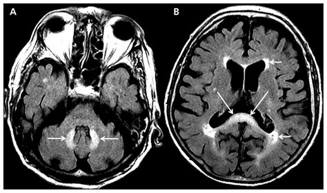 An 82 Year Old Man With Ataxia And Dysarthria Cmaj