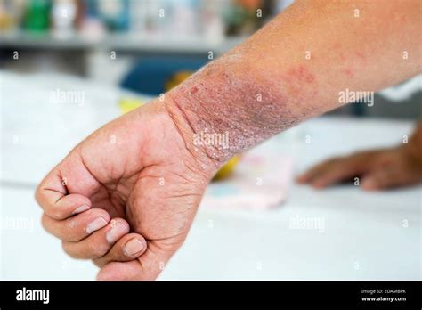 Small Blisters On The Skin Hi Res Stock Photography And Images Alamy