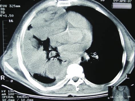 Computed Tomography Of The Patient Exhibits Hilar Lymph Node