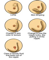 Signs and symptoms you must not ignore according to studies, breast cancer is the most common type of cancer in indian women, accounting to 14 percent of female. Physical signs of possible breast cancer | Download ...