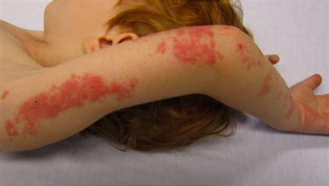This vaccine is called varicella zoster vaccine and available at private sector (not part of our immunization programme). CHICKEN POX VACCINE LINKED TO SHINGLES EPIDEMIC - Birth of ...