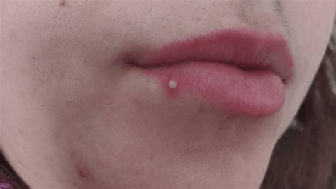 How To Get Rid Of Lip Pimples — Symptoms Causes Remedy By Clara