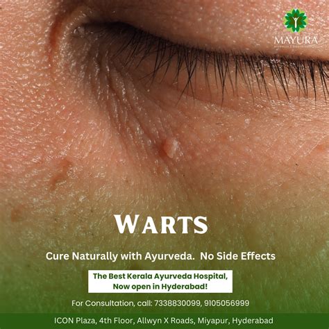 Understanding Warts Causes Symptoms And Treatment Options Mayura