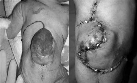 Planning Of The Bilateral Fasciocutaneous Transposition Flap Before