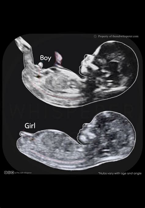 Baby Gender Using Nub Theory Bebek Cinsiyet Tahmini Bebek Ultrason Bebek Cinsiyeti