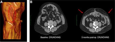 A Volume Rendered Ct Image At 10 Months Postoperative Demonstrating
