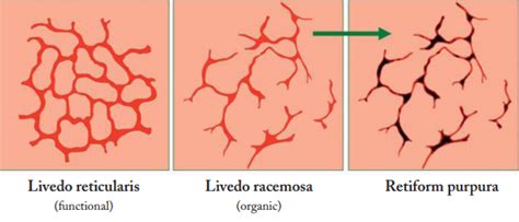Difference Between Livedo Reticularis Livedo Racemosa Livedo