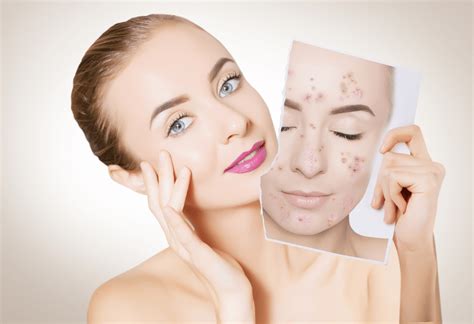 Retinol – one of the best treatments for acne - Skinglow Clinic