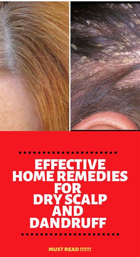 Home Remedies For Dry Scalp And Dandruff Home Remedies Dry Scalp