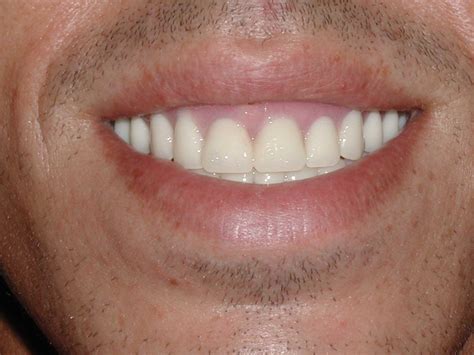 Immediate Denture After Picture - Dr. Caputo | Palm Harbor Dentist
