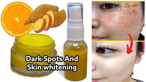 Diy Orange And Potato For Dark Spots Skin Lightening Cream For Acne