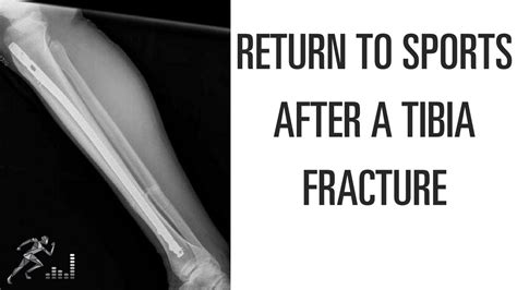 Return To Sports After A Tibia Fracture Youtube