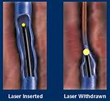 Endovenous Laser Treatment Pictures