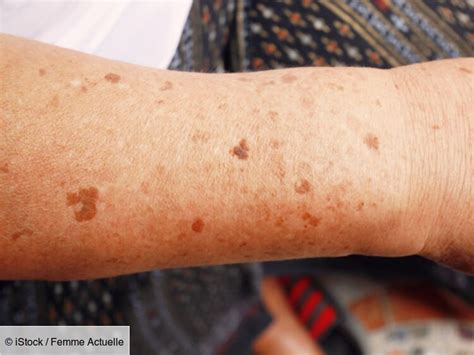 Dark Spots On Arms Hot Sex Picture
