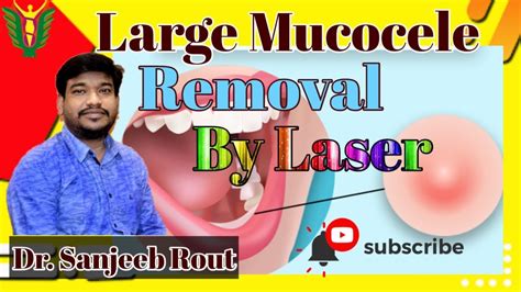 Large Mucocele Removal By Lasers Dr Sanjeeb Rout Youtube