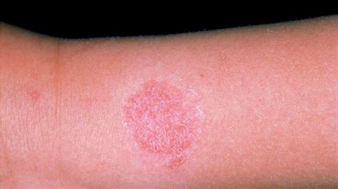 Causes And Cures Of Rashes Parents