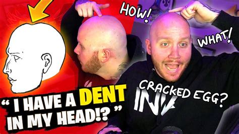 Theres A Dent In My Head And Chat Makes Fun Of It Youtube