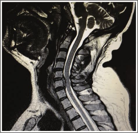 Understanding Cervical Stenosis And Its Surgical Treatment Options