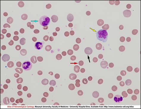 Autoimmune Haemolytic Anaemia Cell Atlas Of Haematological Cytology