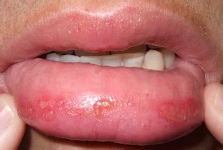 Some people who have contracted herpes on their tongue report the herpes infection can spread beyond the mouth, chin and neck areas and into other areas such as our organs. Herpees