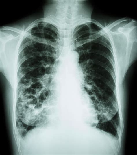 Cystic fibrosis | care guidelines for nutrition management. Researchers Review Importance of Non-Invasive Imaging in ...