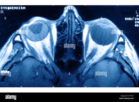 Retinal Detachment Stock Photo Alamy