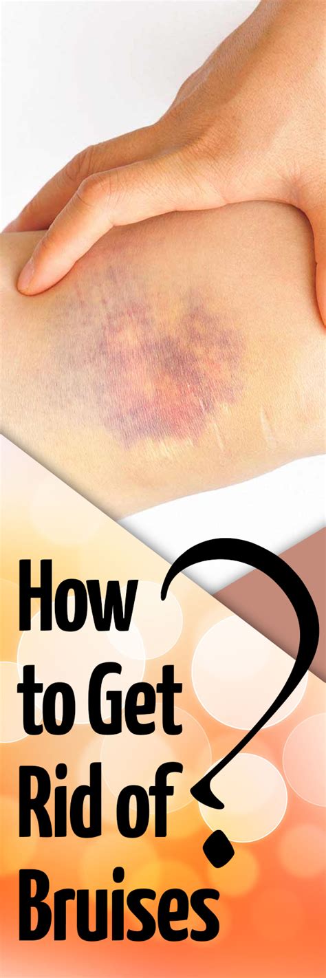 How To Get Rid Of Bruises