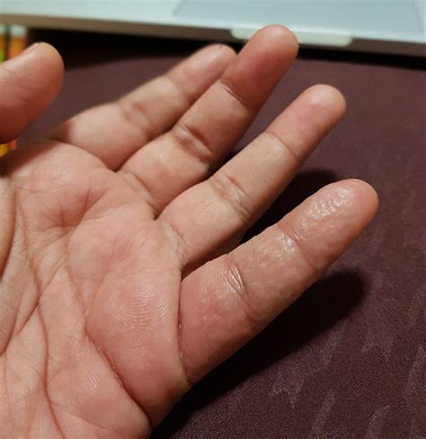 Unusual Swollen Finger Condition Suggestions Required Ketogenic Forums