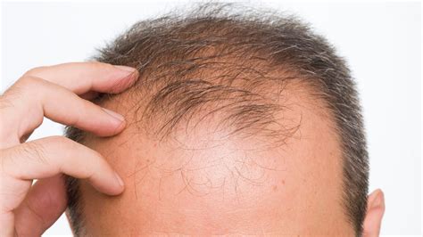 Critical Breakthrough In Cure For Baldness Enm News