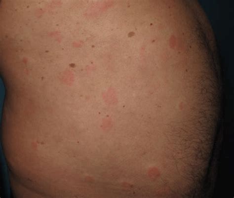 Multiple Erythematous Papules With Hypopigmented Halo Download