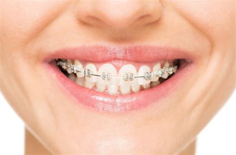 Orthodontics Clear Braces