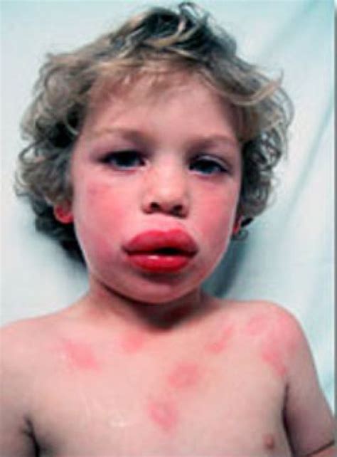 Food allergies may start during infancy. Food allergy. Causes, symptoms, treatment Food allergy