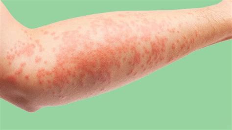 Eczema And Ringworm What S The Difference Flash Uganda Media