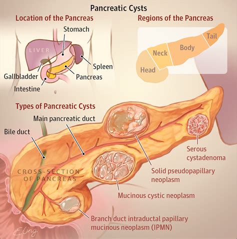 Types Of Pancreatic Cysts Jama 2016316111226 Doi101001jama