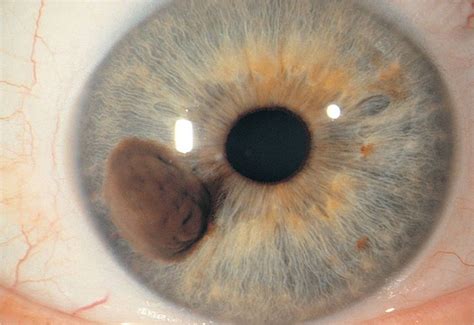 Pupil Iris And Lens Abnormalities Visual Diagnosis And Treatment In