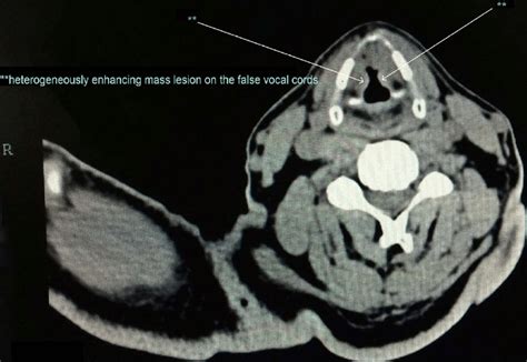 What Are Vocal Cord Cysts Isaac Namdar Md