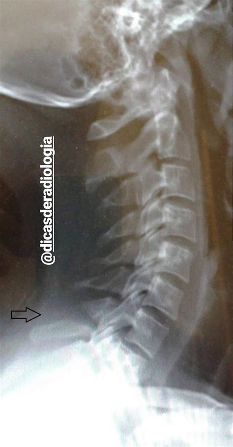 Dicas De Radiologia Tudo Sobre Radiologia Imagens Radiol Gicas Coluna Cervical Fratura C