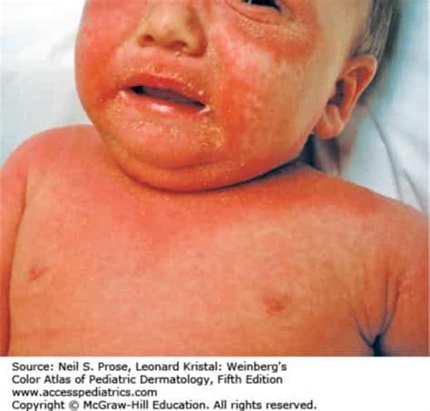 Staphylococcal Scalded Skin Syndrome Staphylococcal Scalded Skin