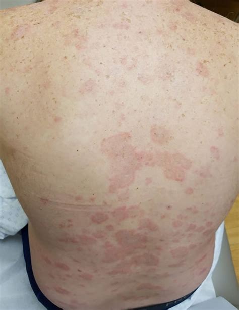 Subacute Cutaneous Lupus Erythematosus With A Possible Paraneoplastic Association With Melanoma