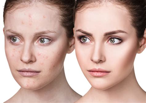 Spironolactone A Highly Effective Treatment For Adult Acne In Women
