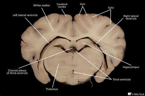 Third Ventricle Sheep Brain