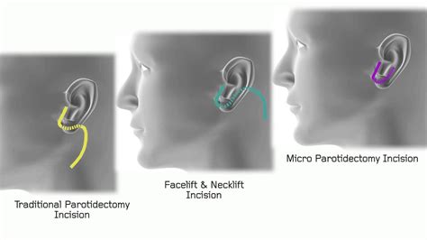 Micro Parotidectomy And Facial Reconstruction Babak Azizzadeh Md Facs