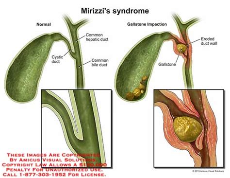 AMICUS Illustration Of Amicus Injury Mirizzi Syndrome Normal Cystic