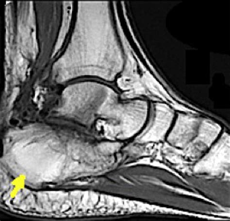 An Intraosseous Lipoma Of The Calcaneus A Case Report The Journal Of