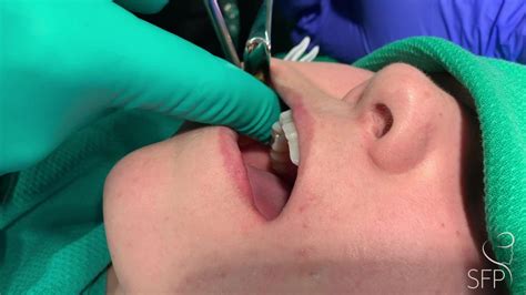 Buccal Fat Removal For Facial Contouring GRAPHIC Video RealSelf