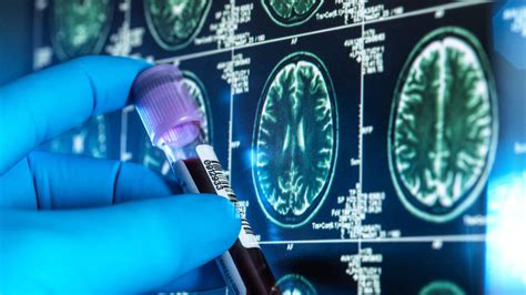 Artificial Intelligence Could Diagnose Dementia In One Scan Lbc