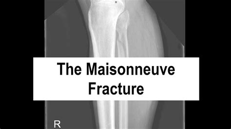 The Maisonneuve Fracture Youtube
