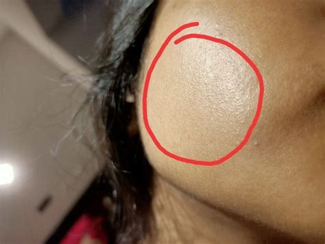 Help Tiny Bumps On My Cheek General Acne Discussion