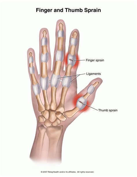 Thumb Sprain Ulnar Collateral Ligament