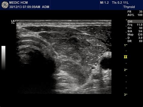 Vietnamese Medic Ultrasound Case Thyroid Toxicosis Periodic